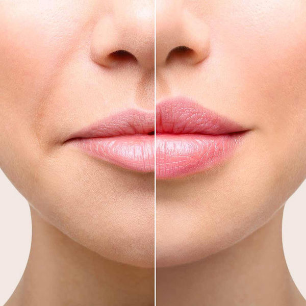 Чем убирают кисетные морщины вокруг рта?